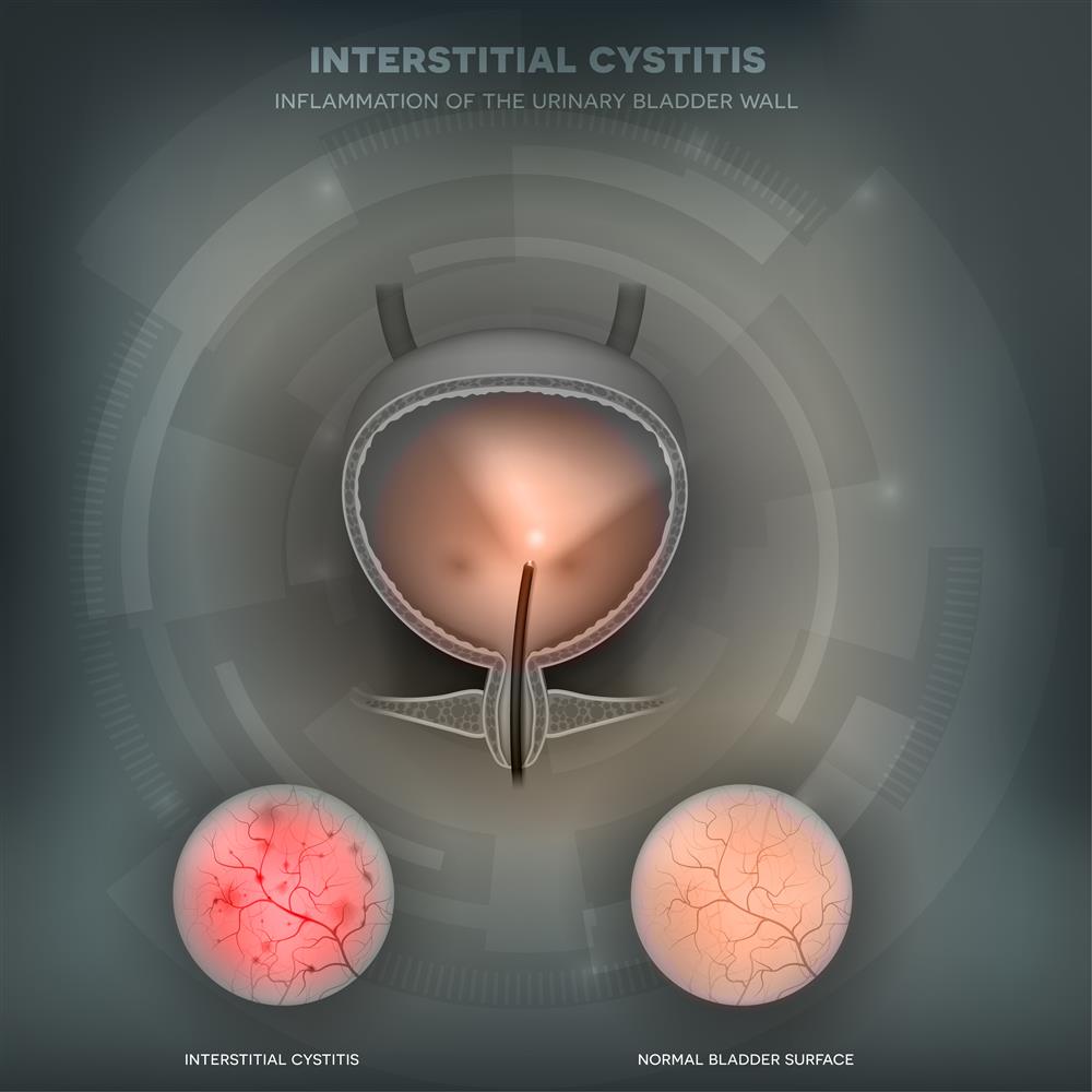 Interstitial Cystitis